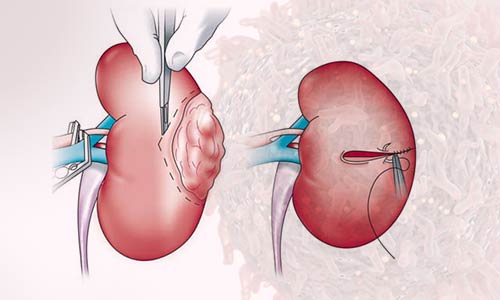 Uro-Oncologist in Nagpur